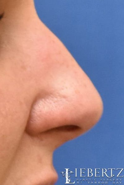 Rhinoplasty Before & After Gallery - Patient 134918 - Image 1