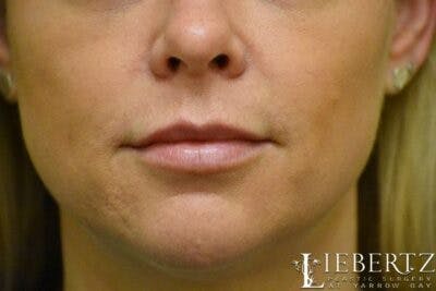 Dermal Fillers Before & After Gallery - Patient 393760 - Image 2