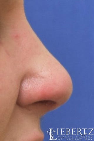 Rhinoplasty Before & After Gallery - Patient 134918 - Image 2