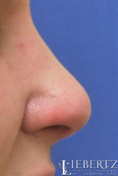 Rhinoplasty Before & After Gallery - Patient 134918 - Image 2