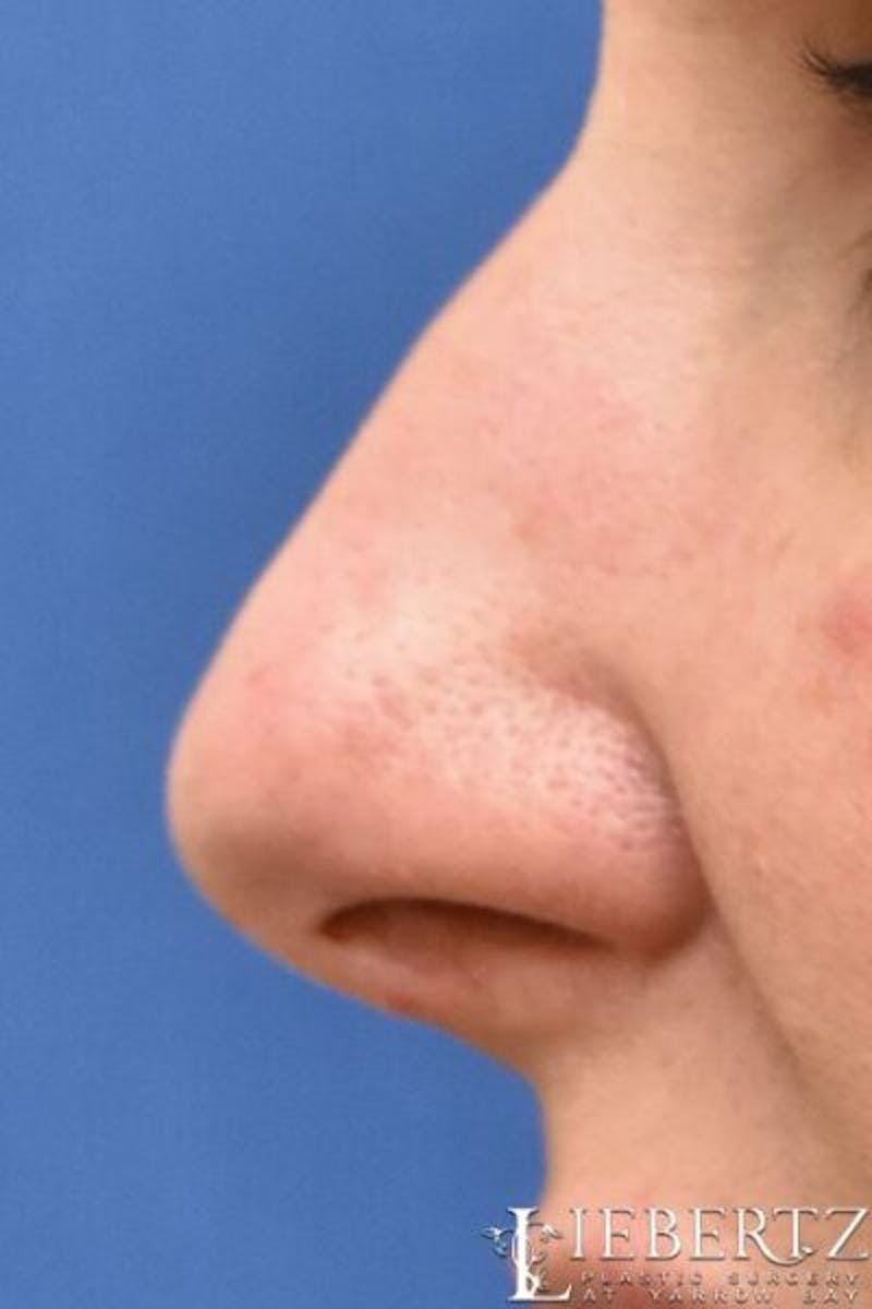 Rhinoplasty Before & After Gallery - Patient 134918 - Image 3