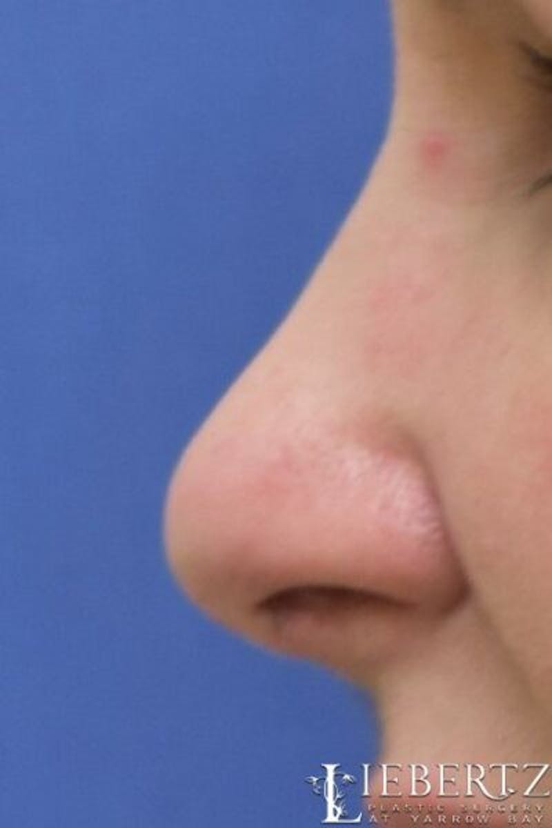 Rhinoplasty Before & After Gallery - Patient 134918 - Image 4
