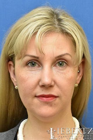 Rhinoplasty Before & After Gallery - Patient 304720 - Image 4