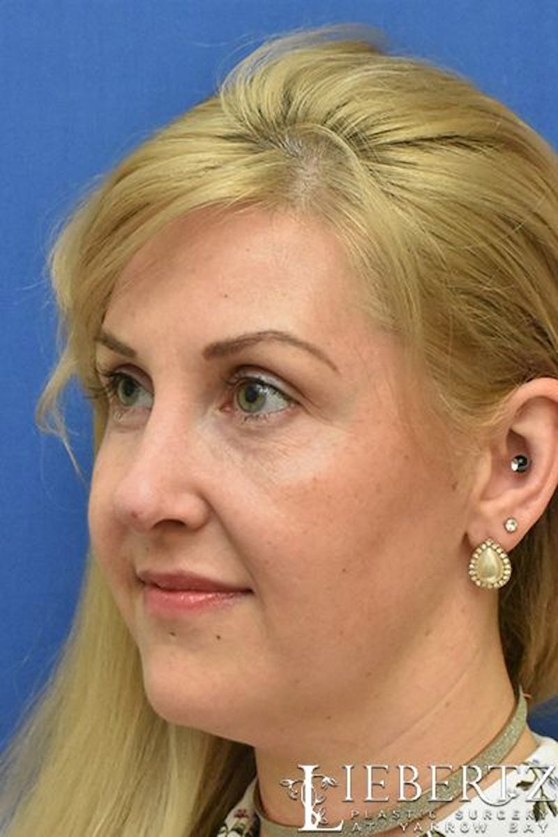 Rhinoplasty Before & After Gallery - Patient 304720 - Image 5