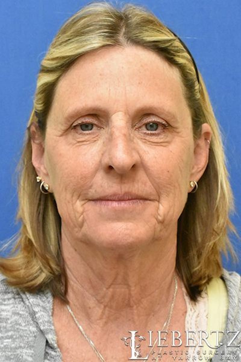 Blepharoplasty Before & After Gallery - Patient 373032 - Image 1