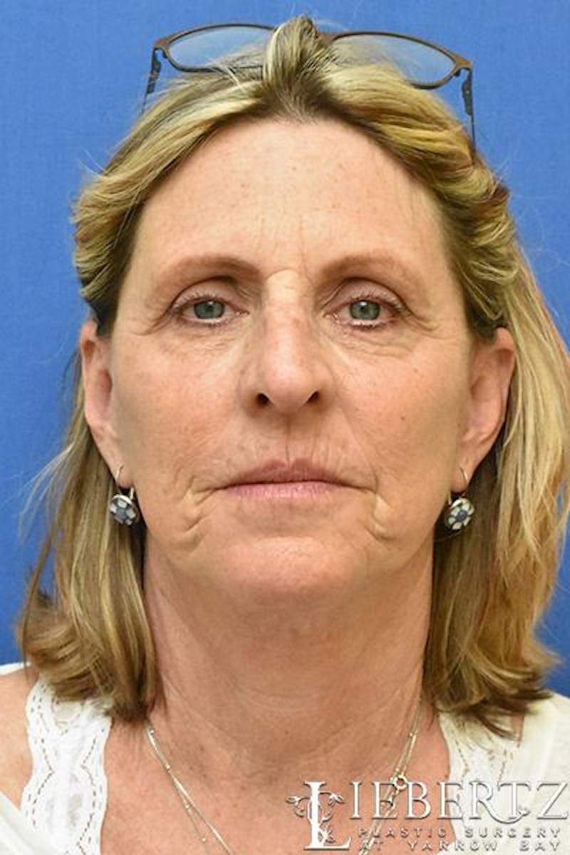 Blepharoplasty Before & After Gallery - Patient 373032 - Image 2