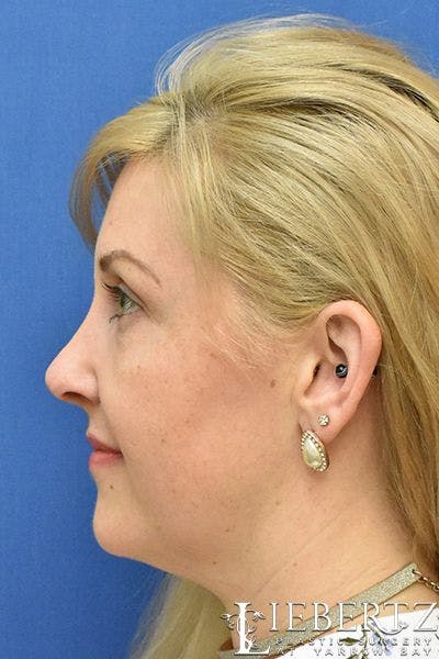 Rhinoplasty Before & After Gallery - Patient 304720 - Image 1