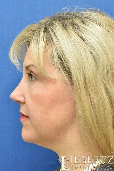Rhinoplasty Before & After Gallery - Patient 304720 - Image 2
