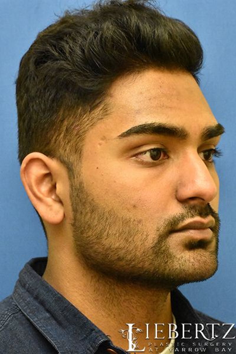Rhinoplasty Before & After Gallery - Patient 168110 - Image 3