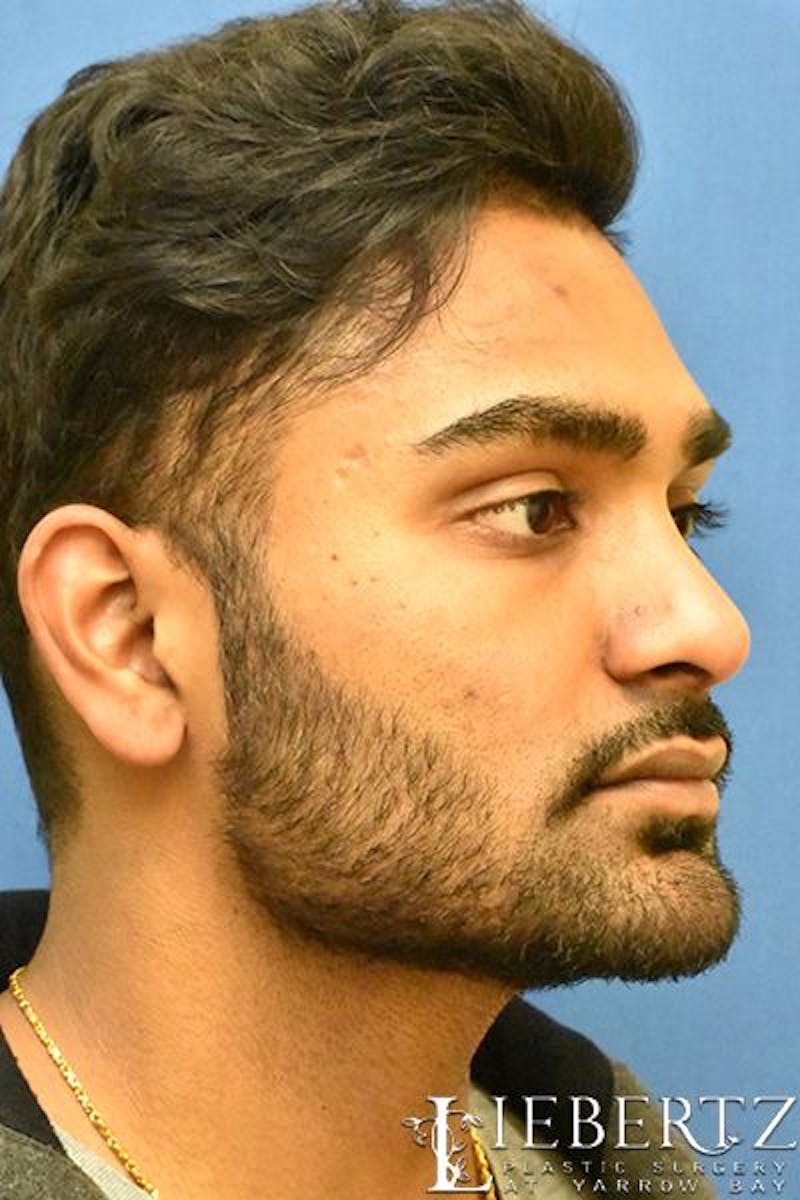 Rhinoplasty Before & After Gallery - Patient 168110 - Image 4