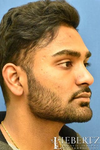 Rhinoplasty Before & After Gallery - Patient 168110 - Image 4