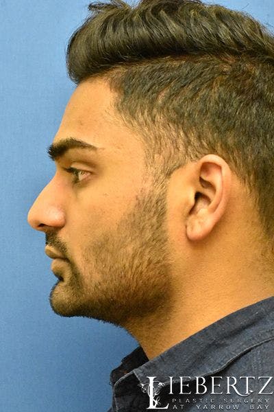 Rhinoplasty Before & After Gallery - Patient 168110 - Image 1