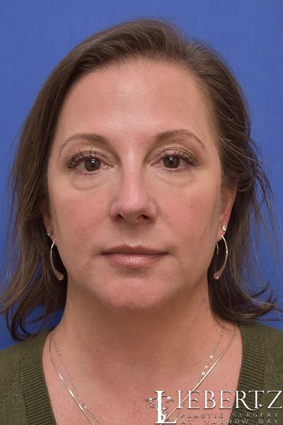 Blepharoplasty Before & After Gallery - Patient 617893 - Image 1