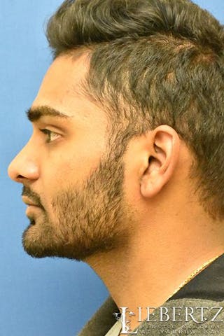 Rhinoplasty Before & After Gallery - Patient 168110 - Image 2