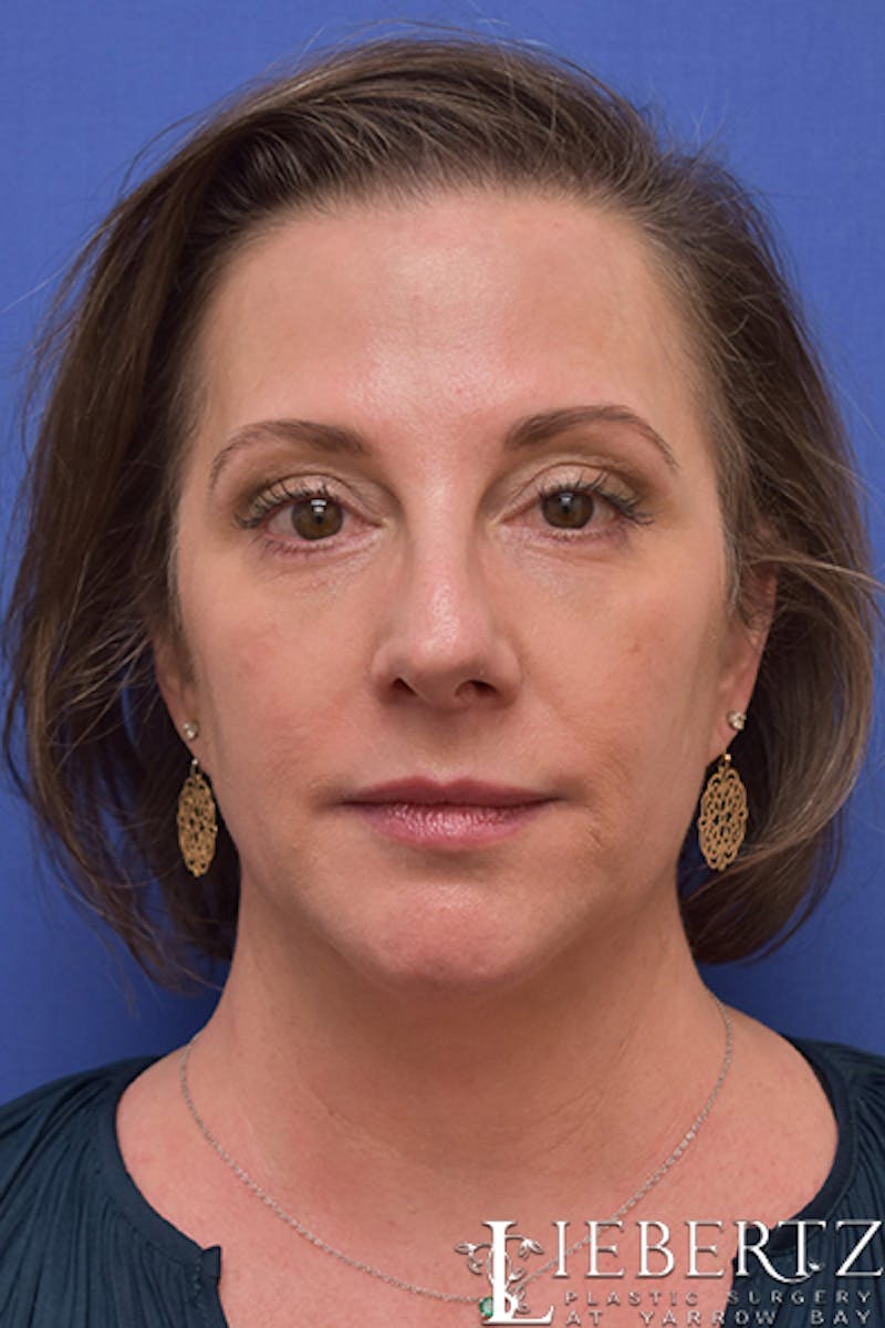 Blepharoplasty Before & After Gallery - Patient 617893 - Image 2