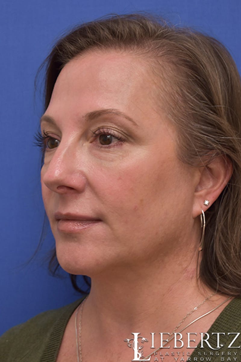 Blepharoplasty Before & After Gallery - Patient 617893 - Image 3