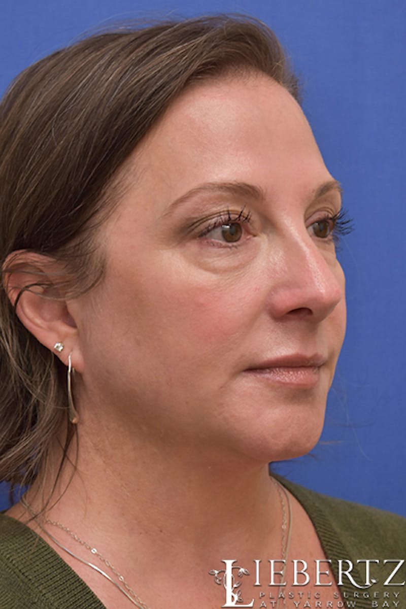 Blepharoplasty Before & After Gallery - Patient 617893 - Image 5