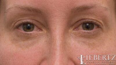 Blepharoplasty Before & After Gallery - Patient 706379 - Image 1