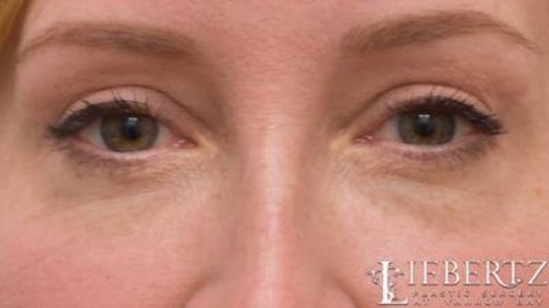 Blepharoplasty Before & After Gallery - Patient 706379 - Image 2