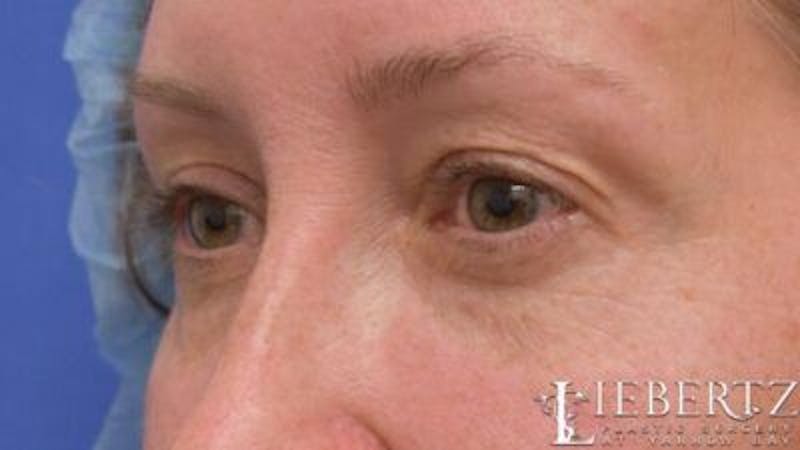 Blepharoplasty Before & After Gallery - Patient 706379 - Image 3