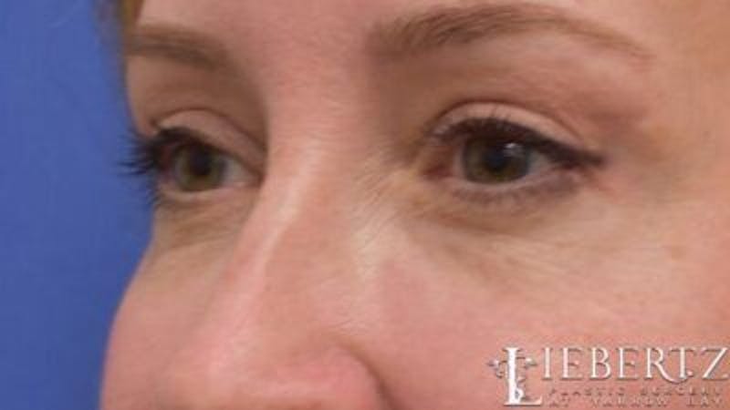 Blepharoplasty Before & After Gallery - Patient 706379 - Image 4