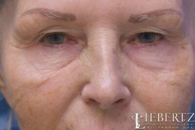 Blepharoplasty Before & After Gallery - Patient 328211 - Image 1