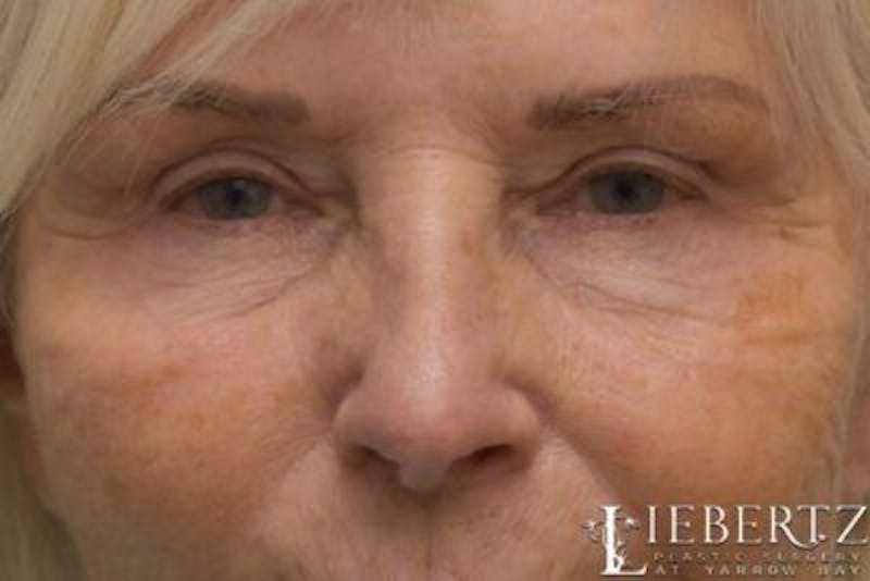 Blepharoplasty Before & After Gallery - Patient 328211 - Image 2