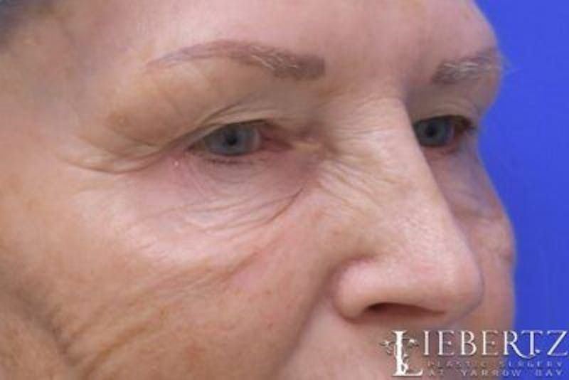 Blepharoplasty Before & After Gallery - Patient 328211 - Image 3