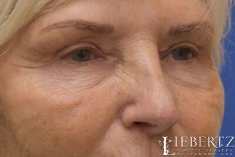 Blepharoplasty Before & After Gallery - Patient 328211 - Image 4