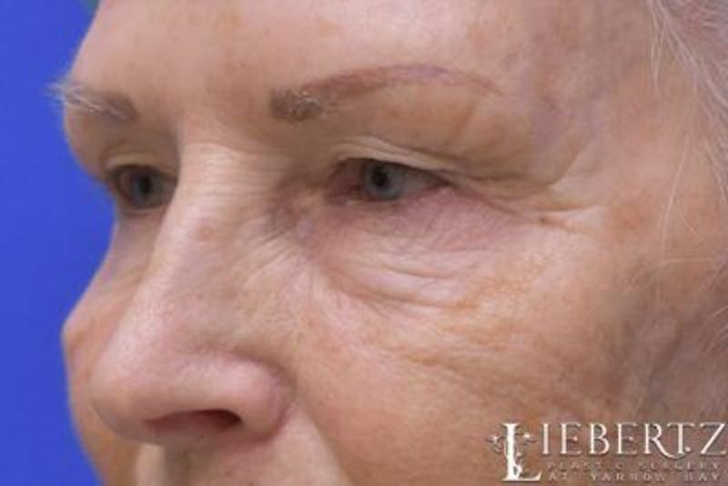Blepharoplasty Before & After Gallery - Patient 328211 - Image 5