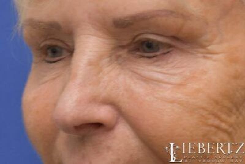 Blepharoplasty Before & After Gallery - Patient 328211 - Image 6