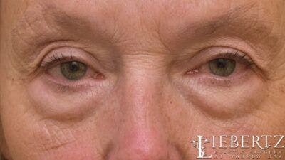 Blepharoplasty Before & After Gallery - Patient 193971 - Image 1