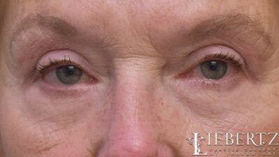Blepharoplasty Before & After Gallery - Patient 193971 - Image 2
