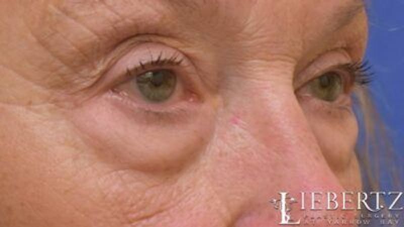 Blepharoplasty Before & After Gallery - Patient 193971 - Image 3
