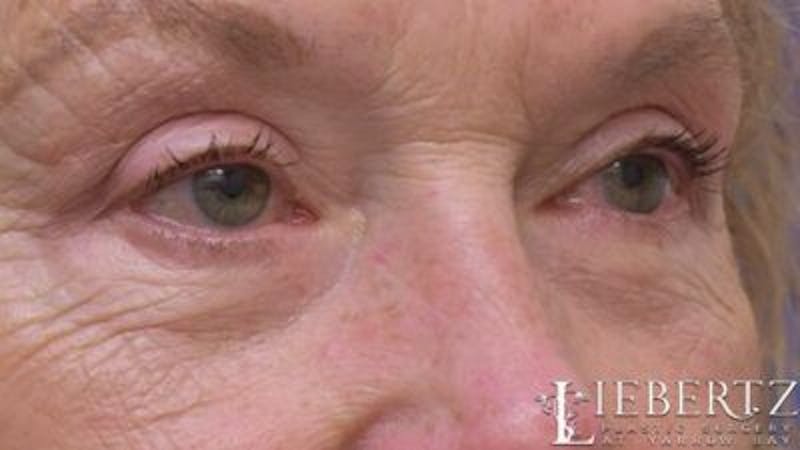 Blepharoplasty Before & After Gallery - Patient 193971 - Image 4