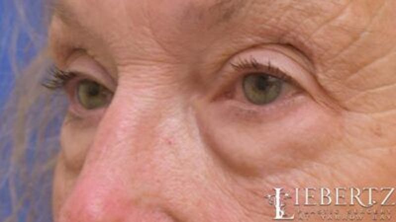 Blepharoplasty Before & After Gallery - Patient 193971 - Image 5