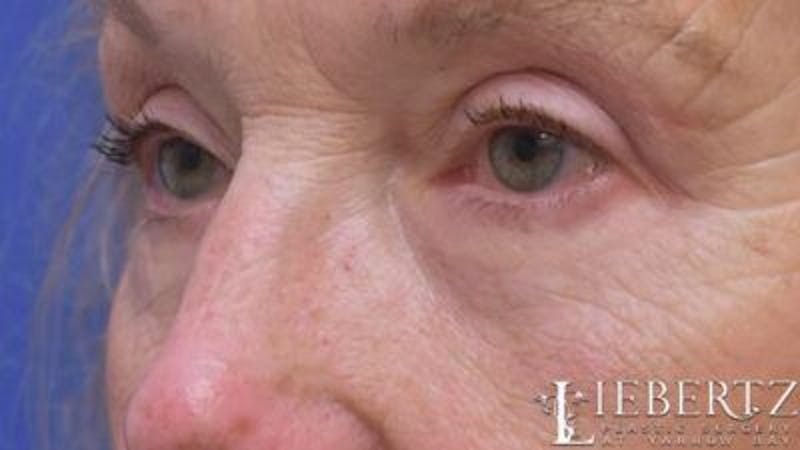 Blepharoplasty Before & After Gallery - Patient 193971 - Image 6