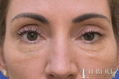 Blepharoplasty Before & After Gallery - Patient 423525 - Image 1