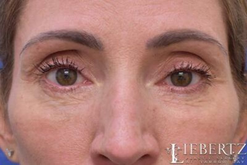 Blepharoplasty Before & After Gallery - Patient 423525 - Image 2