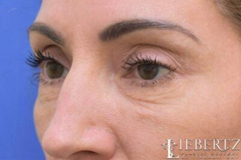 Blepharoplasty Before & After Gallery - Patient 423525 - Image 3