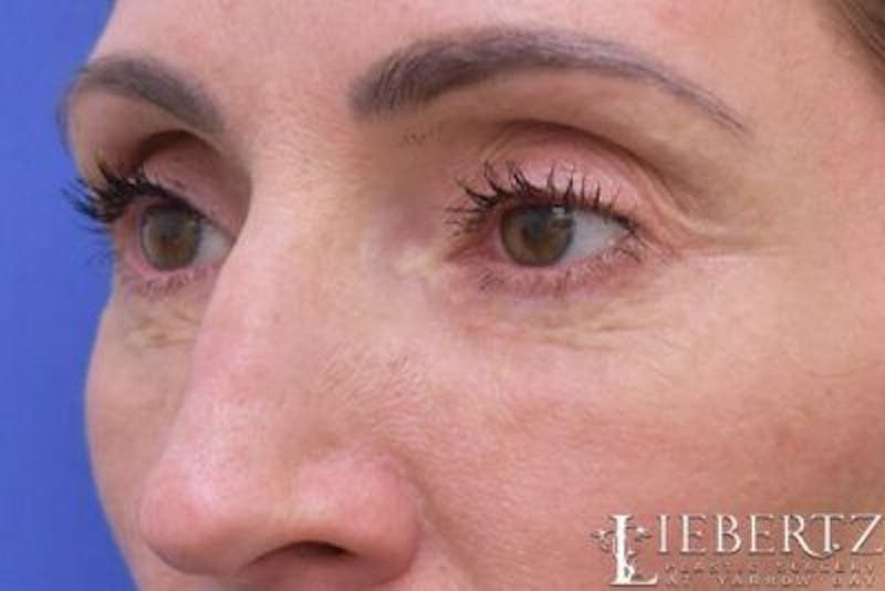 Blepharoplasty Before & After Gallery - Patient 423525 - Image 4