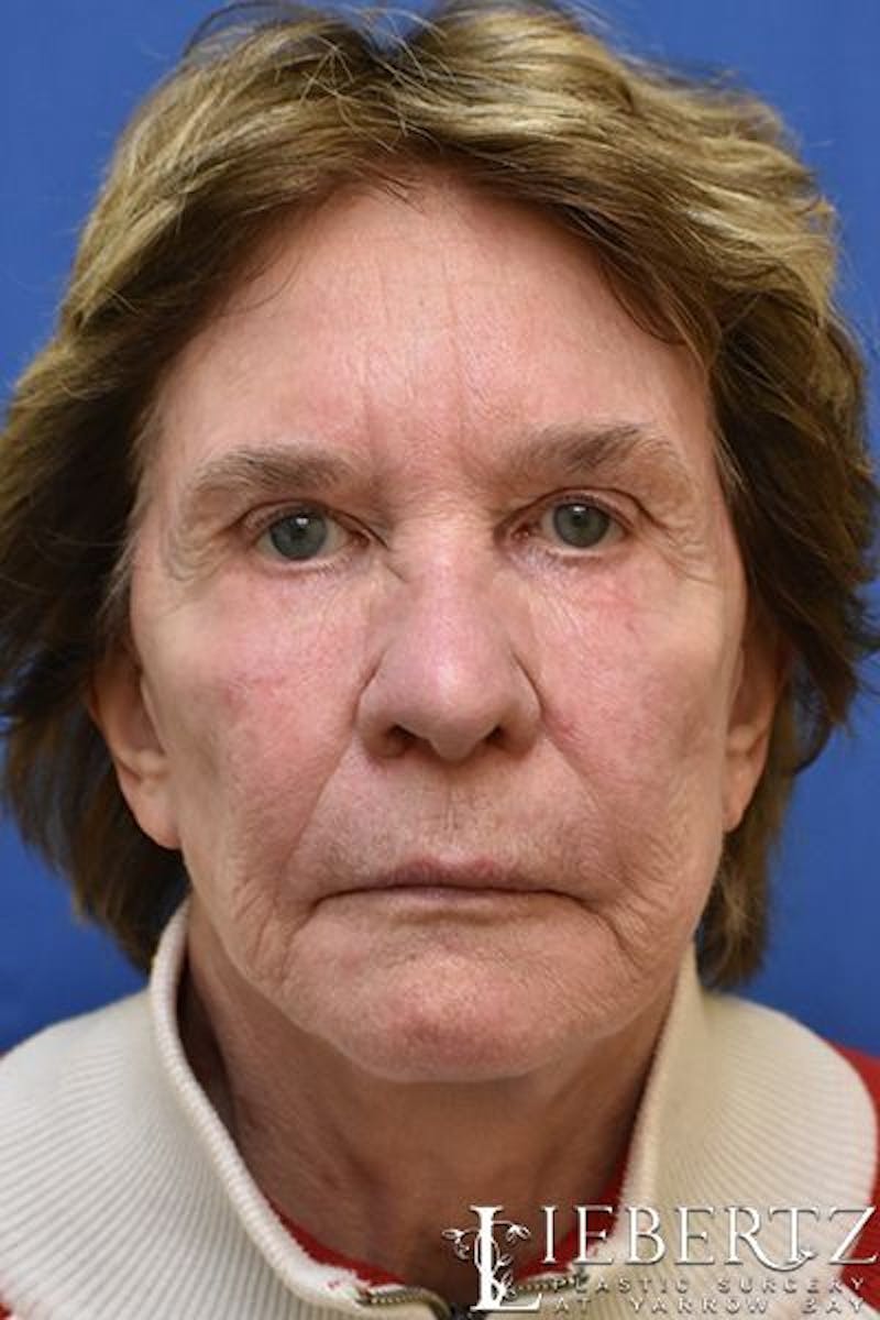 Blepharoplasty Before & After Gallery - Patient 390338 - Image 1