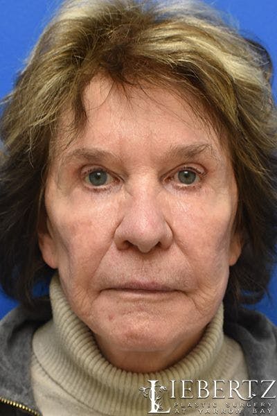 Blepharoplasty Before & After Gallery - Patient 390338 - Image 2