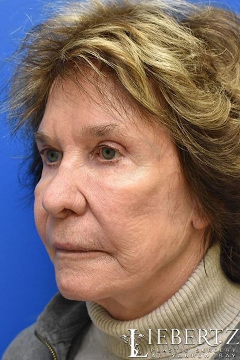 Blepharoplasty Before & After Gallery - Patient 390338 - Image 4