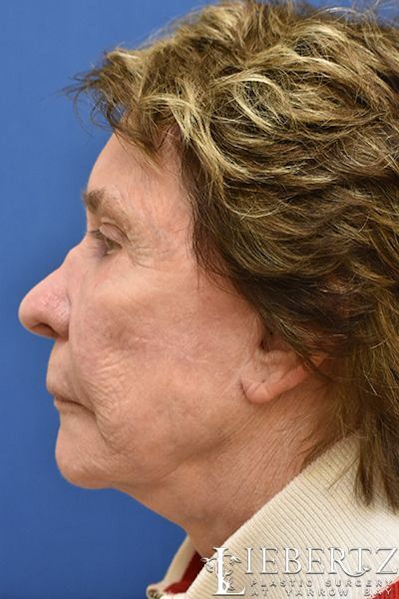 Blepharoplasty Before & After Gallery - Patient 390338 - Image 5