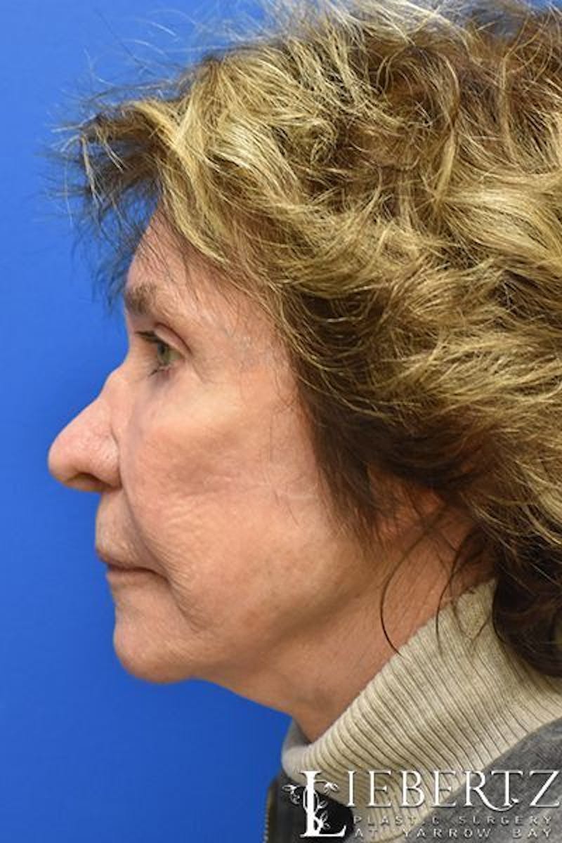 Blepharoplasty Before & After Gallery - Patient 390338 - Image 6