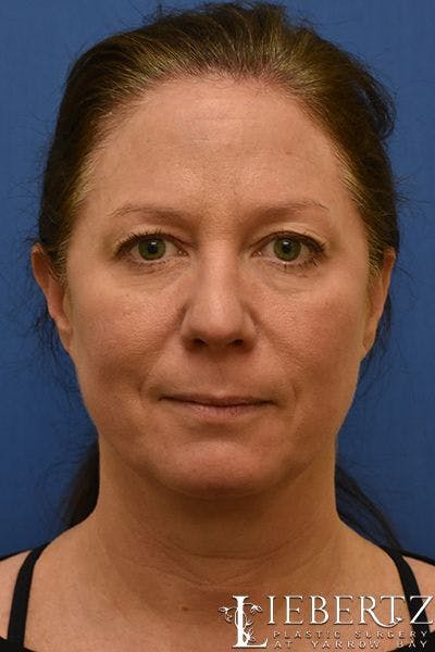 Blepharoplasty Before & After Gallery - Patient 263593 - Image 1