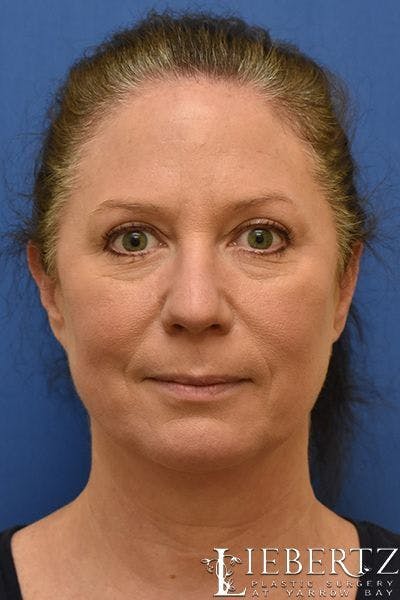 Blepharoplasty Before & After Gallery - Patient 263593 - Image 2