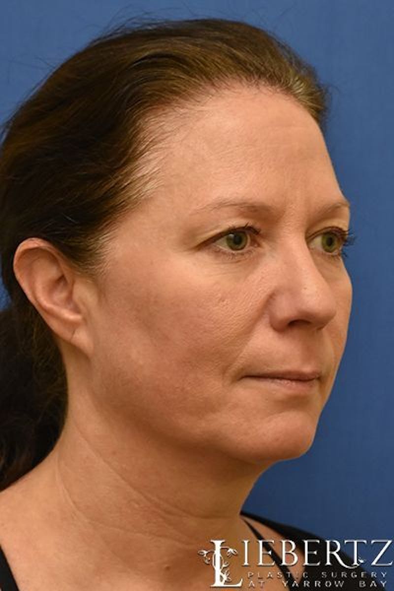Blepharoplasty Before & After Gallery - Patient 263593 - Image 3