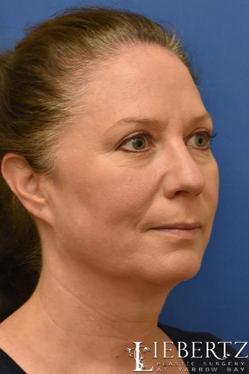 Blepharoplasty Before & After Gallery - Patient 263593 - Image 4